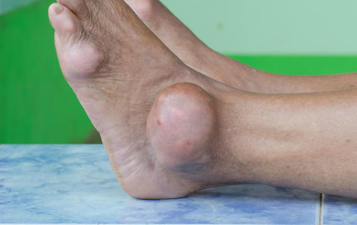 Preventive care for dealing with gout foot pain
